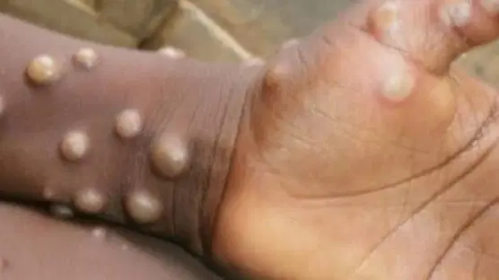 Edo confirms three mpox cases, intensifies tracing